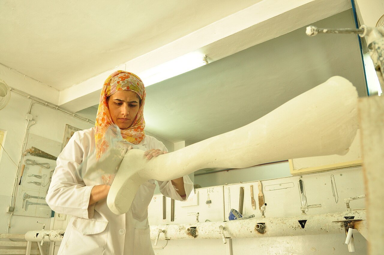 A technician in a white coat smooths a plaster limb mold at a bench in an orthopedic workshop, with hand tools mounted on the wall behind.